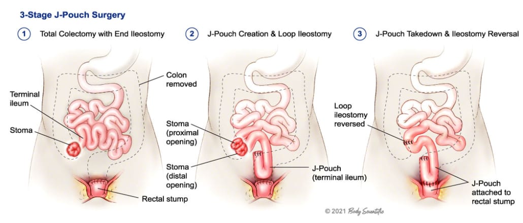 J-Pouch Information l United Ostomy Associations of America