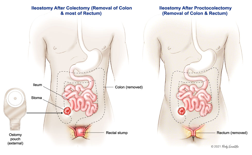Colostomy Procedure | Doctor Stock