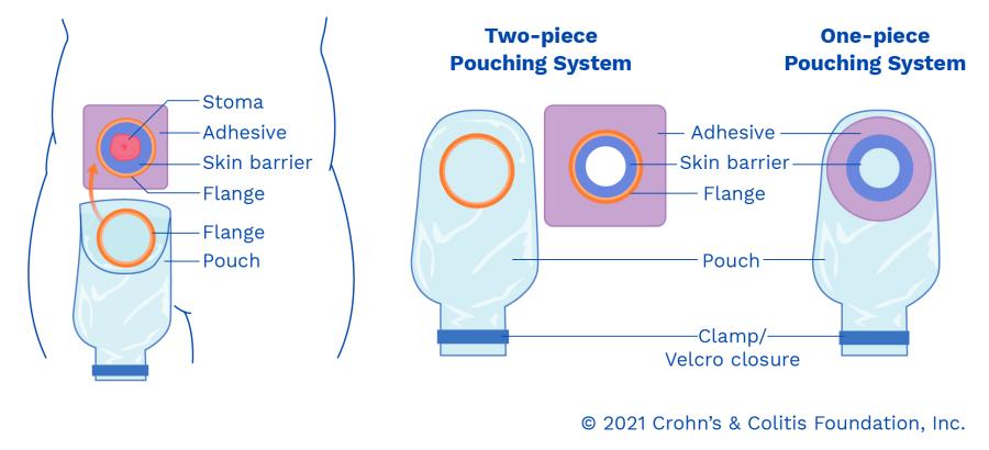 Types Of Pouching Systems L United Ostomy Association Of America