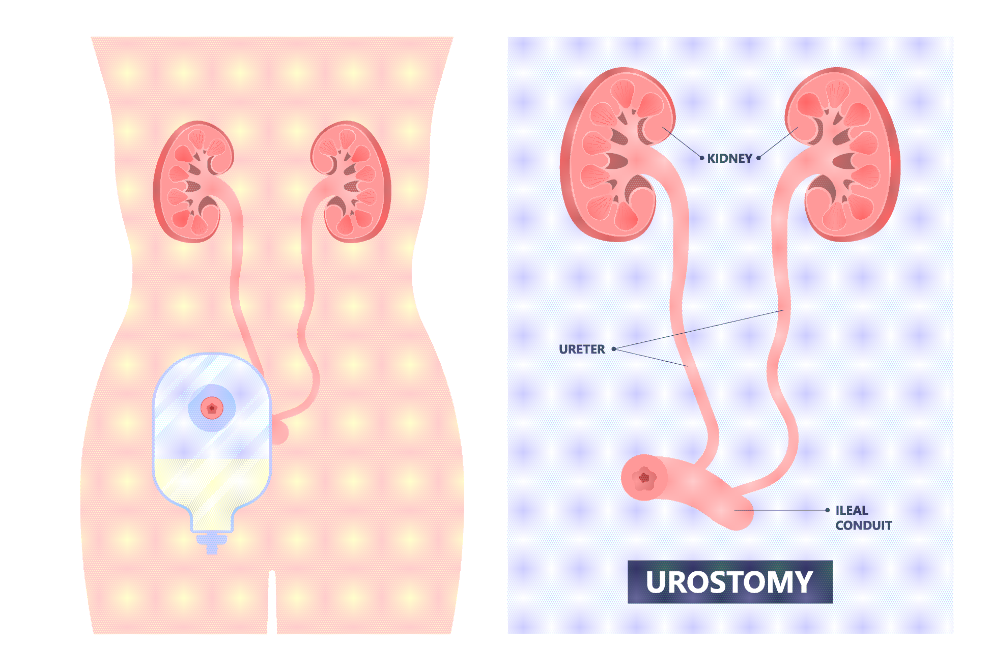 A Quick Guide to Urostomy Basics - United Ostomy Associations of America