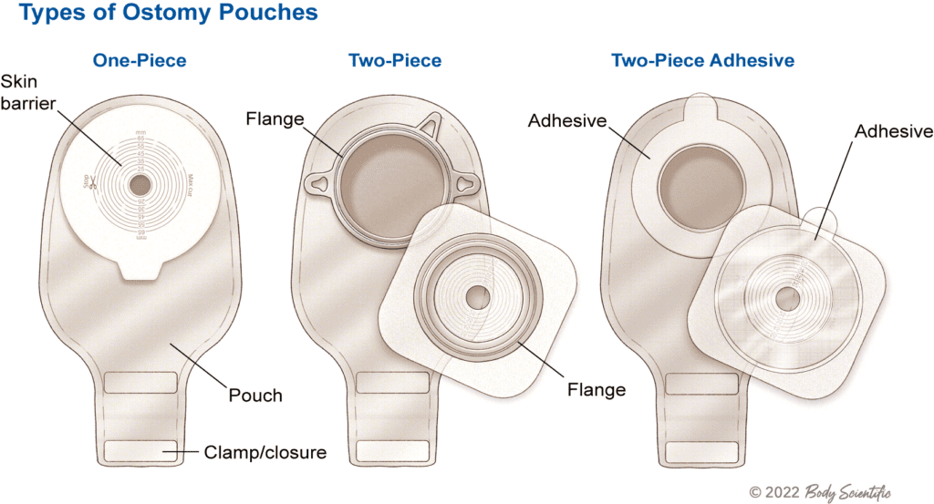Types of Pouching Systems l United Ostomy Association Of America