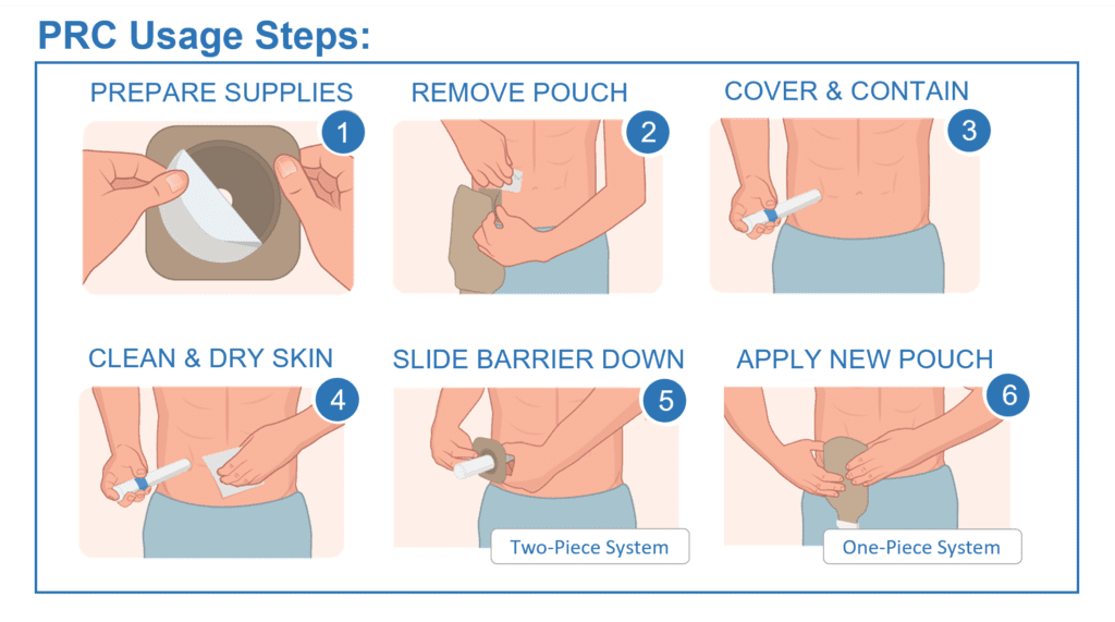 How to Remove Stoma Pouch Adhesive From The Skin